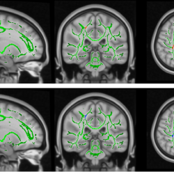Researchers explore the neuropathological reasons that lead to the perpetration of child maltreatment by maltreating mothers
