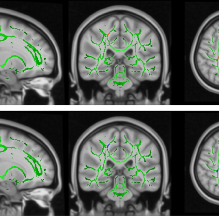 Researchers explore the neuropathological reasons that lead to the perpetration of child maltreatment by maltreating mothers
