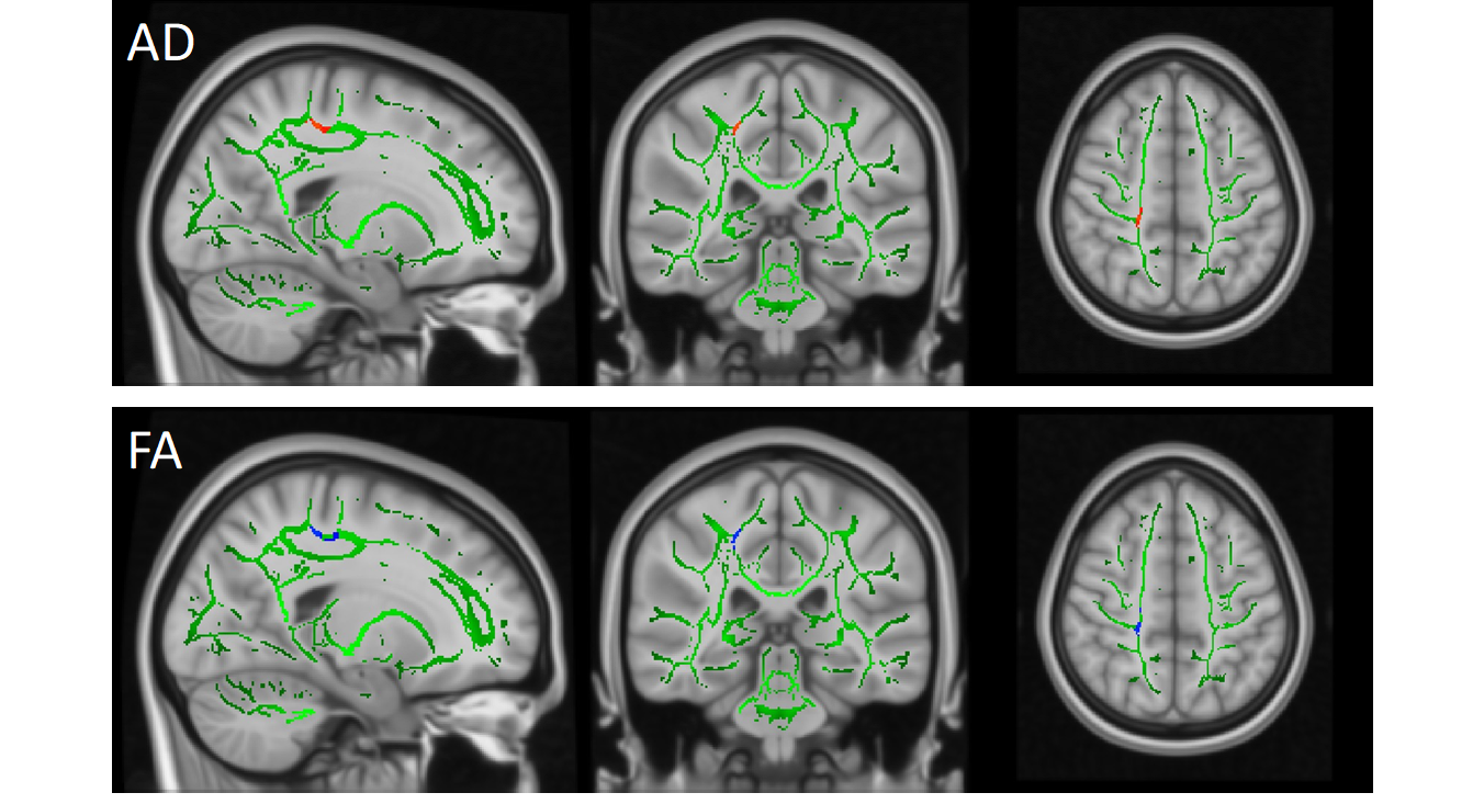 Researchers explore the neuropathological reasons that lead to the perpetration of child maltreatment by maltreating mothers  